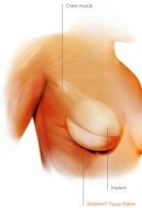 alloderm breast-recon-savannah-ga