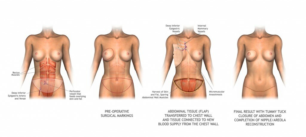 diep flap reconstruction surgery 