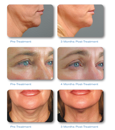 Ultherapy-before-after before and after pictures of Ultherapy skin tightening