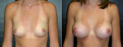 breast augmentation savannah breast augmentation savannah ga